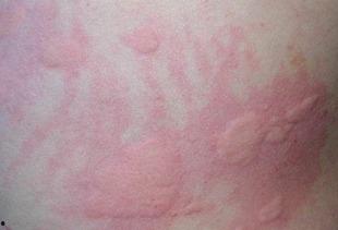 皮肤过敏吃茭瓜行吗